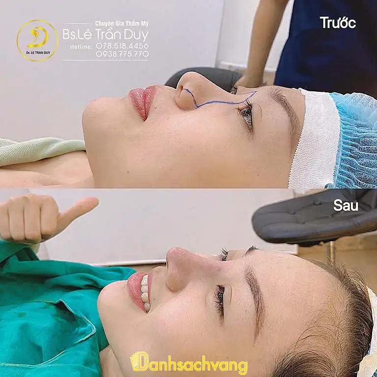 Hình ảnh bóc Phốt nâng mũi bác sĩ lê trần duy có tốt không