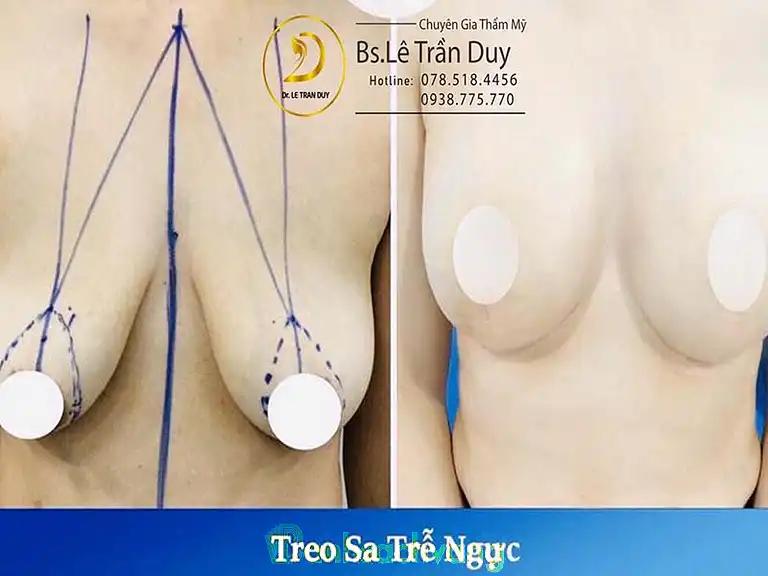 Hình ảnh 10 Địa chỉ treo ngực sa trễ ở TPHCM uy tín, bác sĩ giỏi