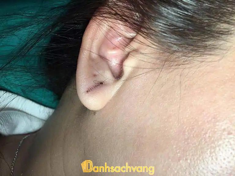 Hình ảnh 5 Địa chỉ Vá lỗ tai thẩm mỹ tại TPHCM đẹp và uy tín