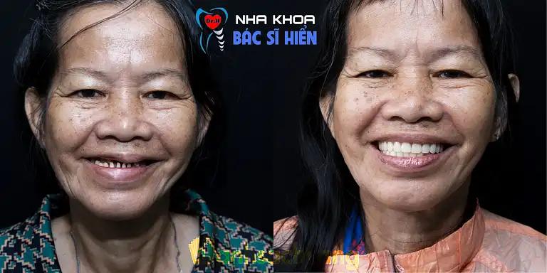 Hình ảnh nha-khoa-bac-si-hien-2