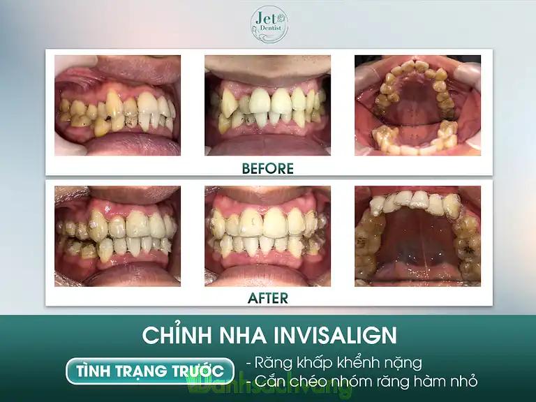 Hình ảnh nha-khoa-jet-dentist-ton-duc-thang-dong-da-ha-hoi-3