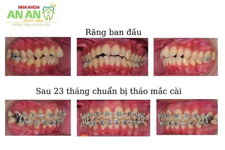 Hình ảnh Nha Khoa An An: 2U Nguyễn Thị Tần, Quận 8