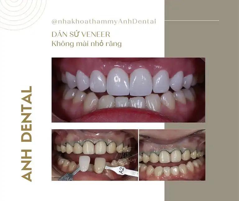 Hình ảnh vien-nha-khoa-tham-my-anh-dental-khuong-viet-qtan-phu-tphcm-2