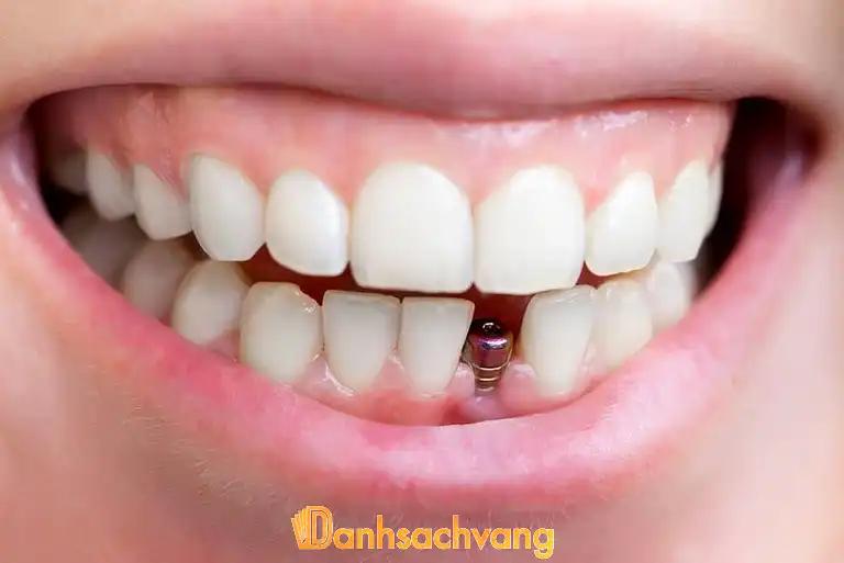 Hình ảnh dia-chi-trong-rang-implant-tai-tphcm