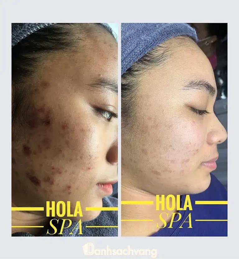 Hình ảnh hola-spa-1614-go-meo-dan-phuong-3