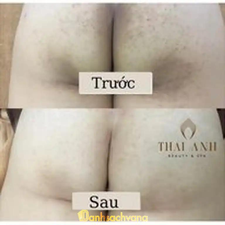 Hình ảnh thai-anh-beauty-spa-me-tri-nam-tu-liem-4