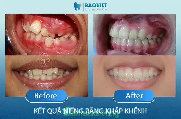 Hình ảnh nha-khoa-bao-viet-8-vu-thanh-dong-da-3