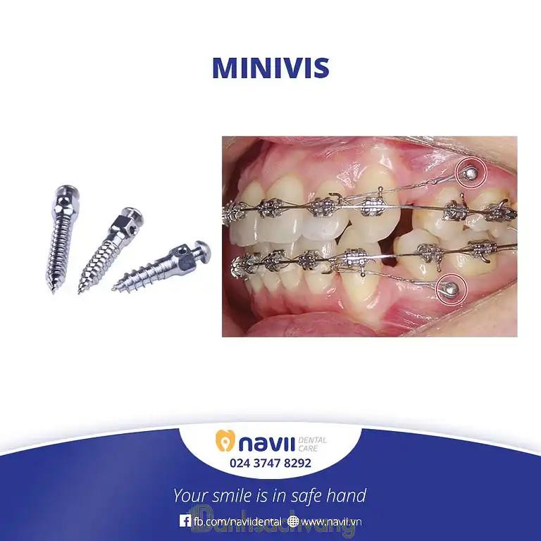 Hình ảnh navii-dental-care-42-cua-dong-hoan-kiem-4