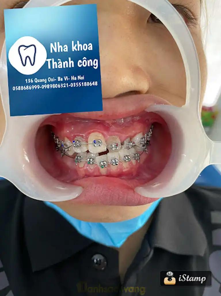 Hình ảnh nha-khoa-thanh-cong-136-quang-oai-ba-vi-23