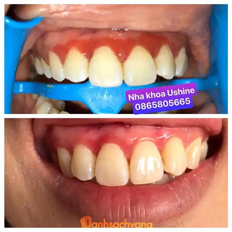 Hình ảnh nha-khoa-ushine-khu-bo-ho-me-linh-4
