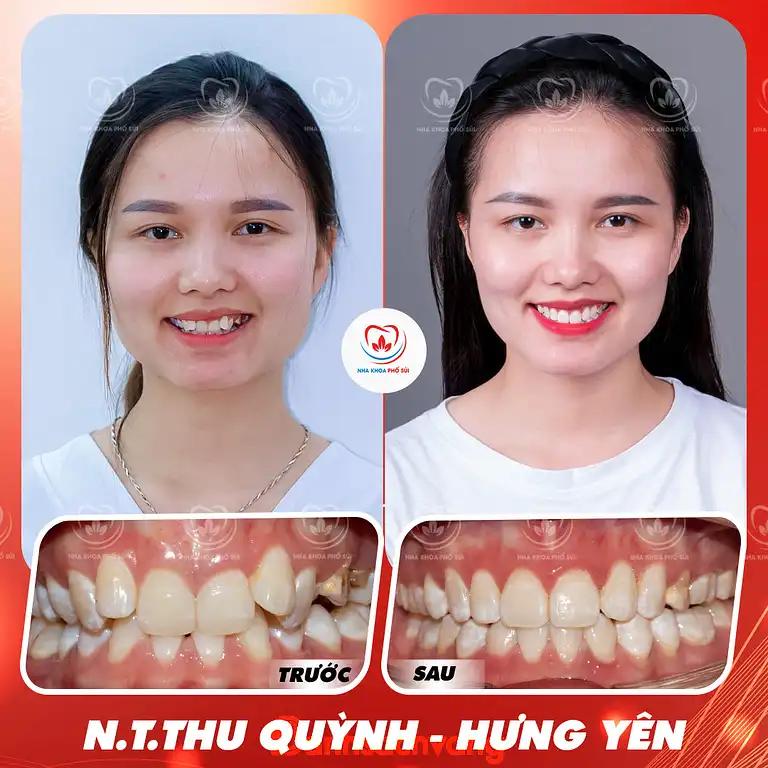 Hình ảnh nha-khoa-pho-sui-nga-4-pho-sui-gia-lam-2