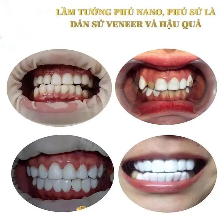 Hình ảnh phong-rang-minh-huong-5