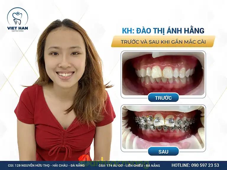Hình ảnh nha-khoa-viet-han-174-au-co-lien-chieu-5