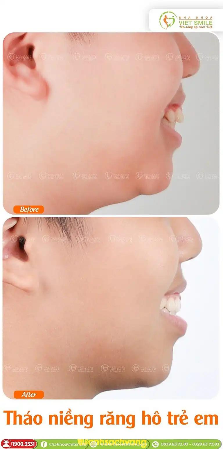 Hình ảnh nha-khoa-viet-smile-4