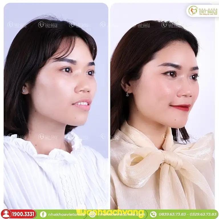 Hình ảnh nha-khoa-viet-smile-1