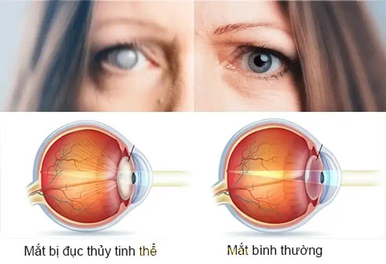 Hình ảnh khoa-mat-benh-vien-nhan-dan-gia-dinh-3