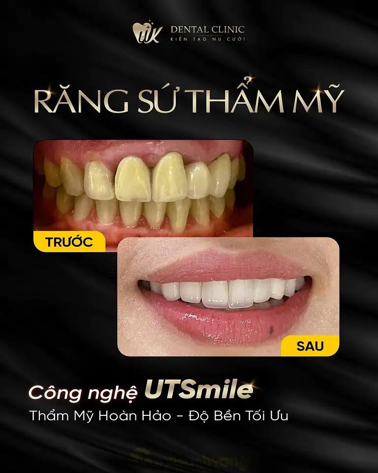Hình ảnh nha-khoa-uk-lo-12-nv-08-kdt-tp-nha-trang-4