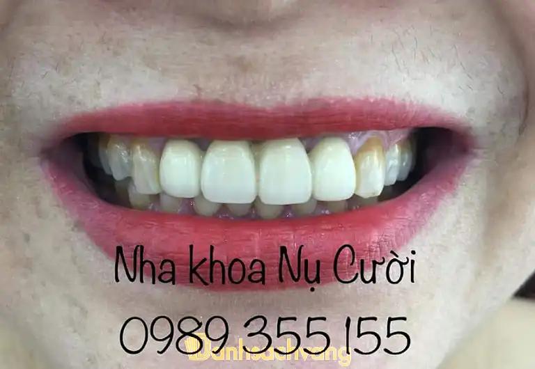 Hình ảnh nha-khoa-nu-cuoi-1-nguyen-hoang-ton-tay-ho-4