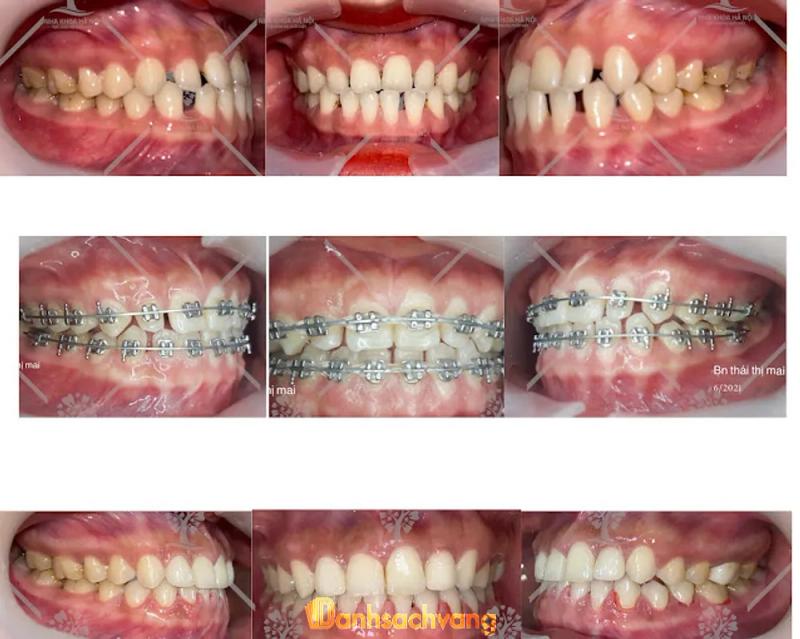 Hình ảnh Nha khoa Hà Nội (Halo Smile): 26 Trần Cung, Cầu Giấy