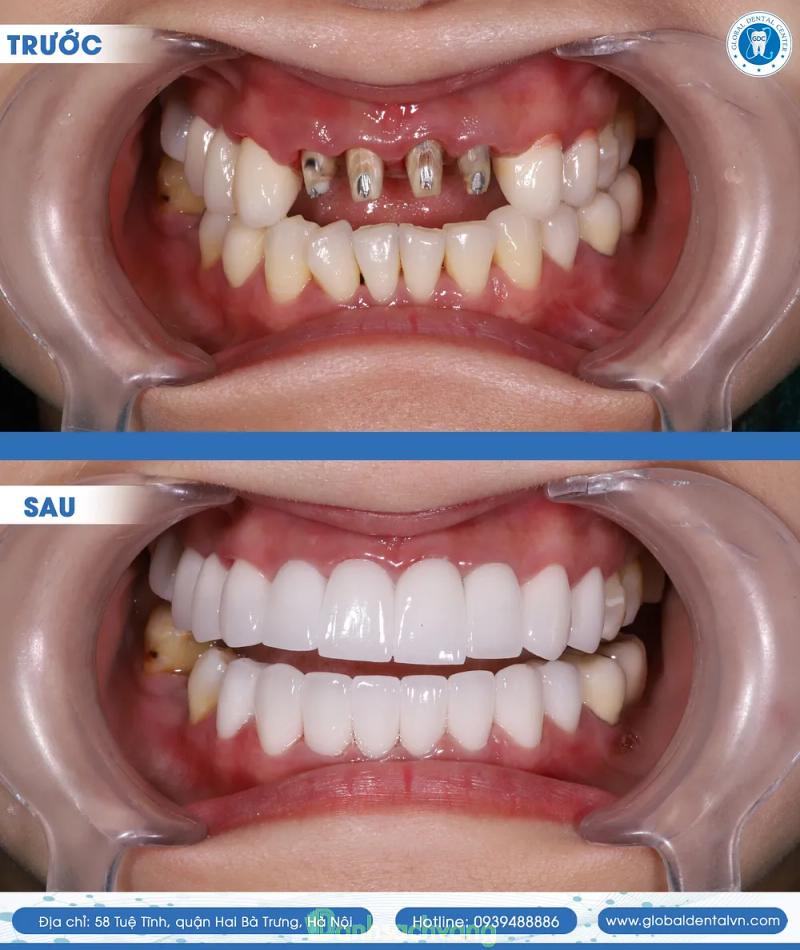 Hình ảnh Nha khoa Global Dental: 58 Tuệ Tĩnh, Hai Bà Trưng, Hà Nội
