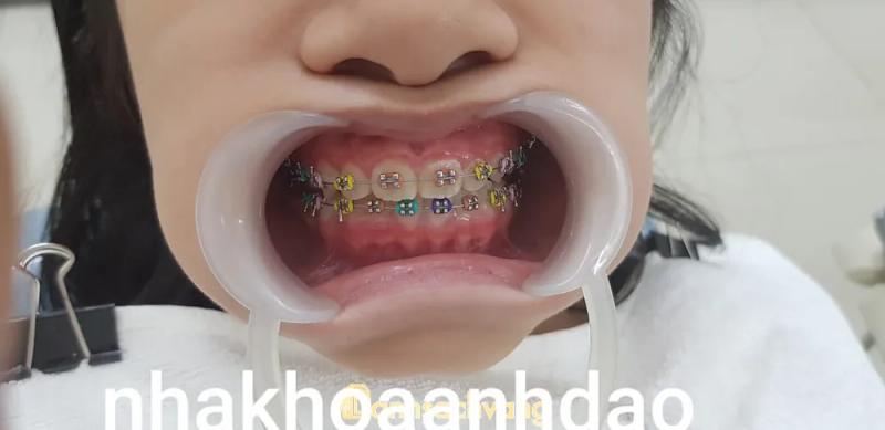 Hình ảnh Nha khoa Anh Đào: 54 Lê Duẩn, Hoàn Kiếm, Hà Nội