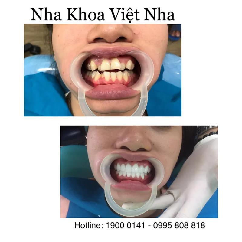 Hình ảnh Nha khoa Việt Nha: 825 Hùng Vương, H. Di Linh