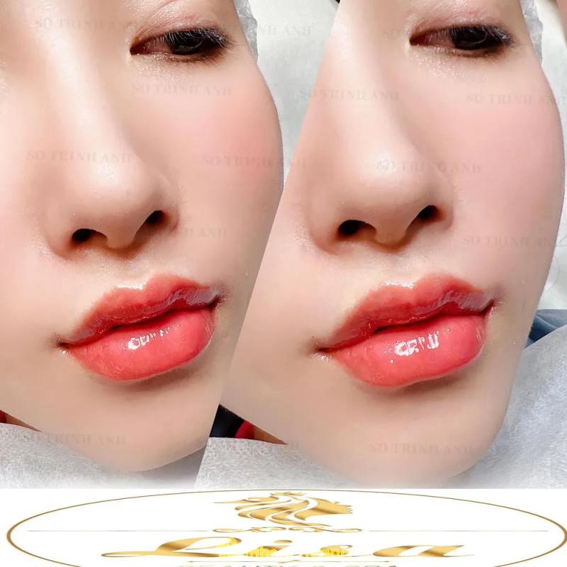 Hình ảnh Viện Thẩm Mỹ Lisa: 66 Chi Lăng, TP Hòa Bình