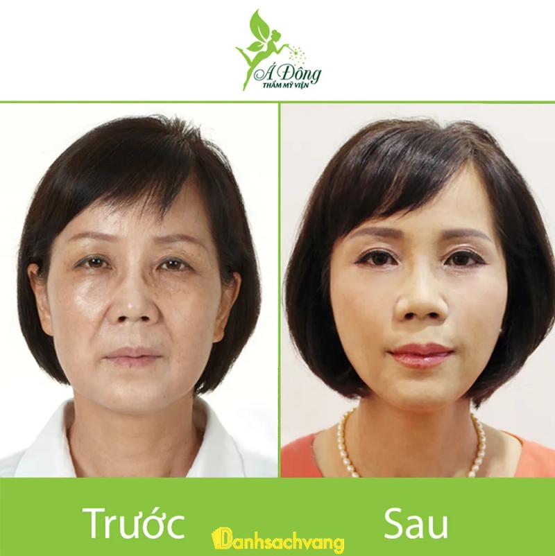 Hình ảnh Căng Da Mặt Bằng Chỉ: 39 Sương Nguyệt Anh, Quận 1