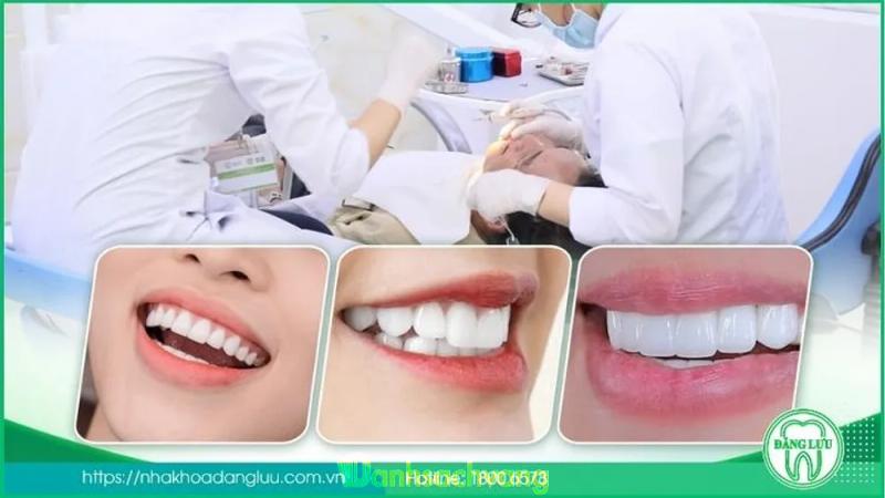 Hình ảnh bọc răng sứ ở nha khoa đăng lưu
