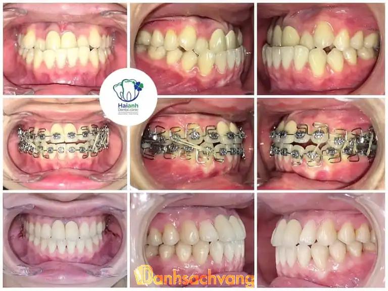 Hình ảnh trung-tam-nha-khoa-tham-my-hai-anh-46-mieu-dam-nam-tu-liem-3