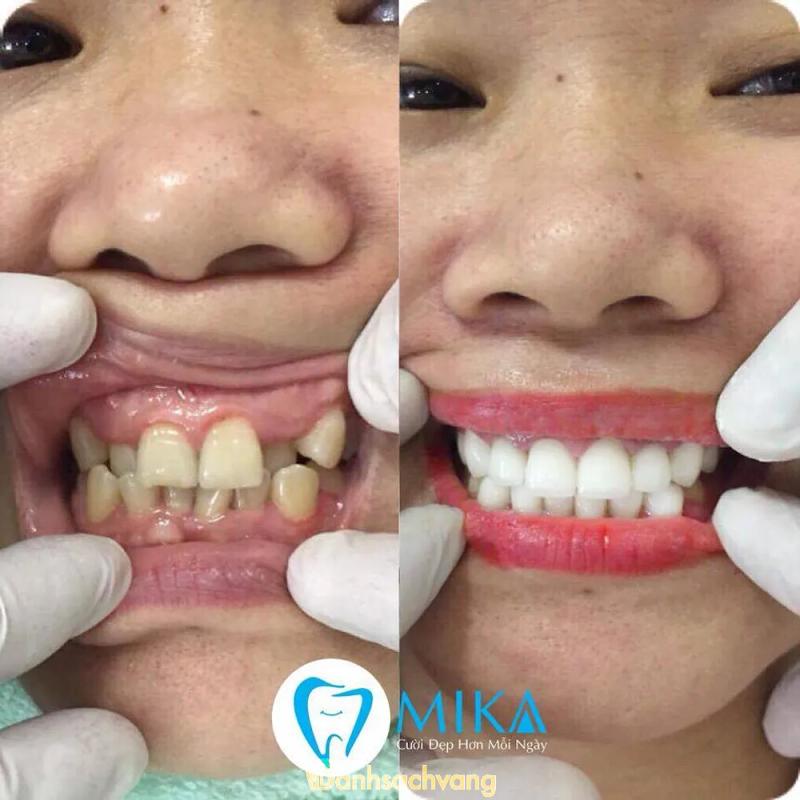 Hình ảnh Nha khoa quốc tế MIKA: 64 Lý Thường Kiệt, Tp Vinh, Nghệ An