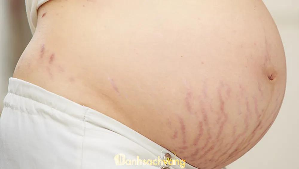 Hình ảnh 10 Spa trị rạn da sau sinh tại TPHCM tốt, hiệu quả nhanh