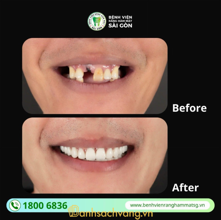 Bệnh Viện Răng Hàm Mặt Sài Gòn: Địa chỉ cấy ghép Implant