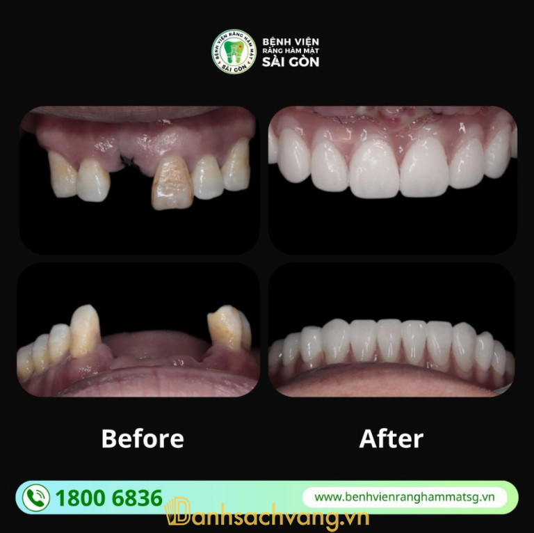 Bệnh Viện Răng Hàm Mặt Sài Gòn: Địa chỉ cấy ghép Implant