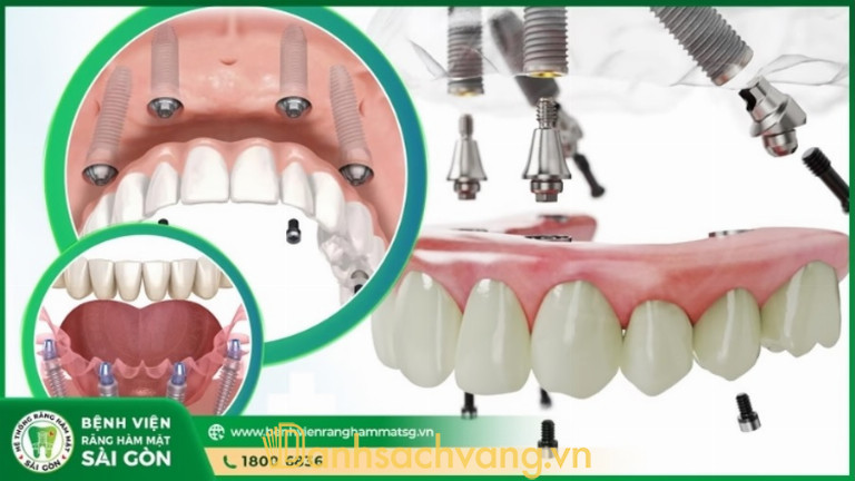 Trồng răng Implant tại Bệnh Viện Răng Hàm Mặt Sài Gòn