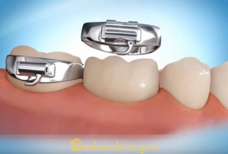 Band là một vòng kim loại nhỏ, cấu tạo giống hình dáng răng