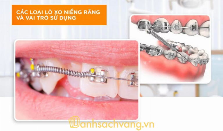 Lò xo sử dụng chủ yếu cho trường hợp niềng răng mắc cài