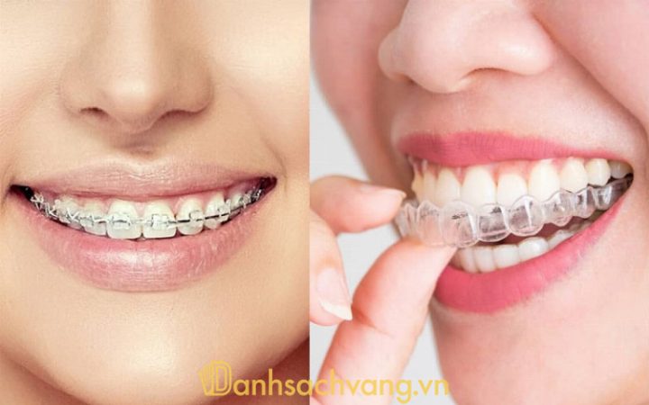 Giải đáp: Nên niềng răng trong suốt hay mắc cài?