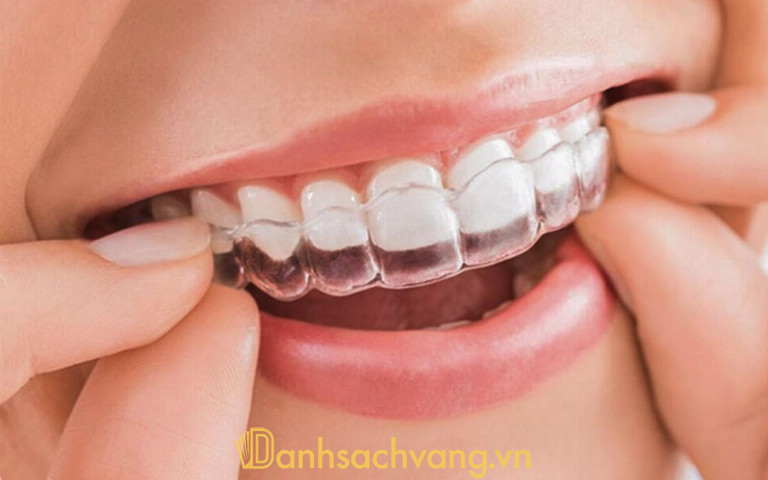 Niềng răng trong suốt phù hợp với khách hàng yêu cầu cao về thẩm mỹ, có tài chính tốt