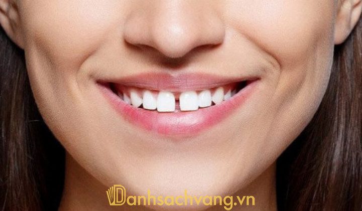 Răng thưa có niềng được không? Giải đáp nhanh gọn