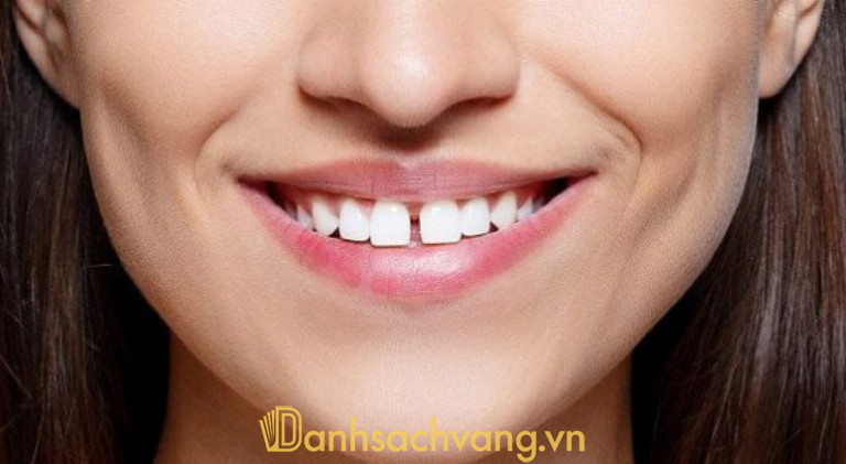 Răng thưa có nên niềng không
