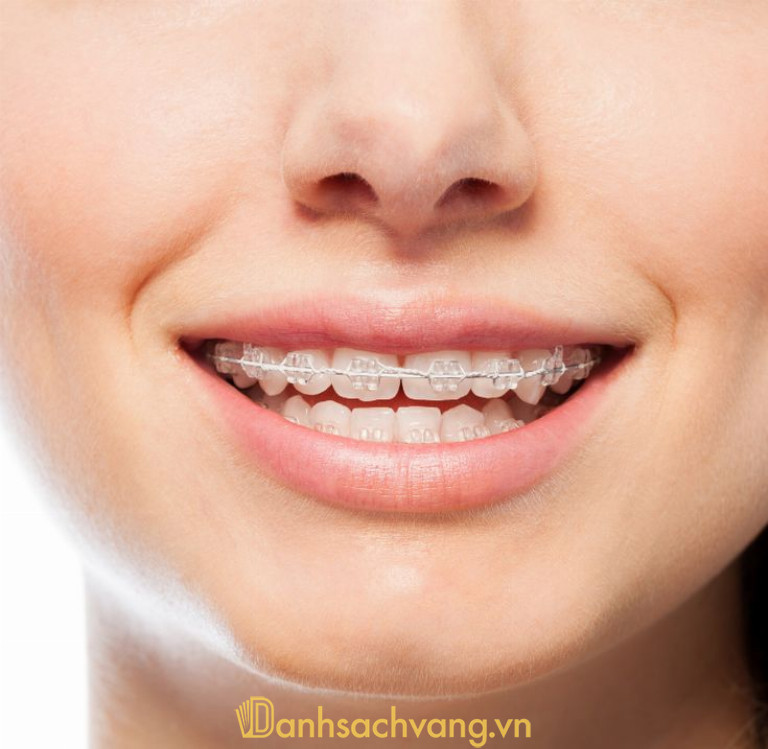 Răng thưa có niềng được không