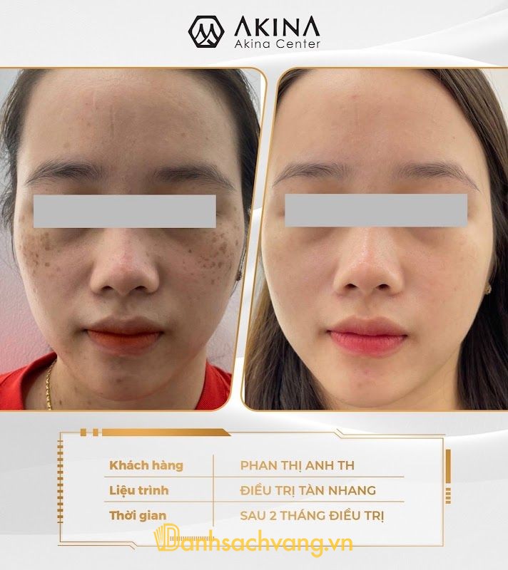 AKINA CENTER - spa trị mụn ở Huế