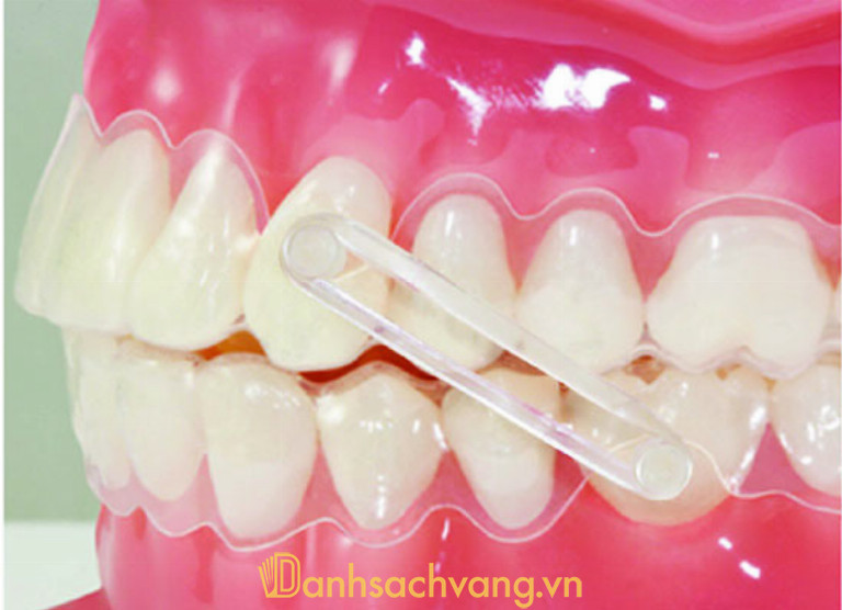 Thun liên hàm có thiết kế giống những chiếc thun thông thường nhưng độ đàn hồi rất cao